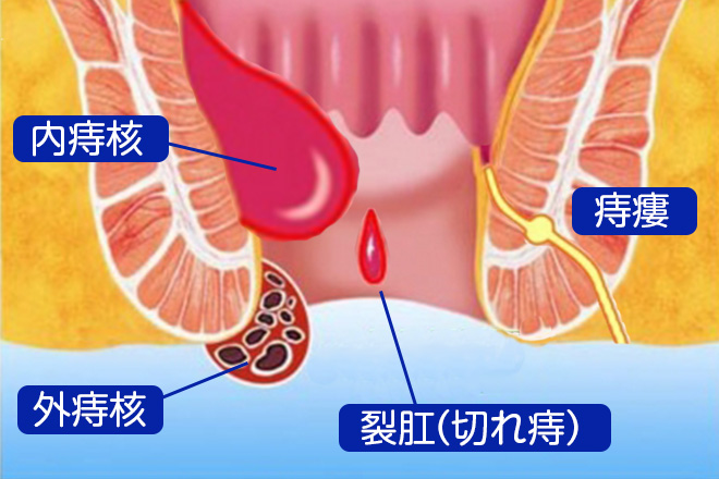 主な肛門疾患の種類