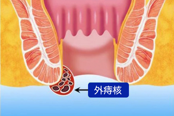 外痔核の症状