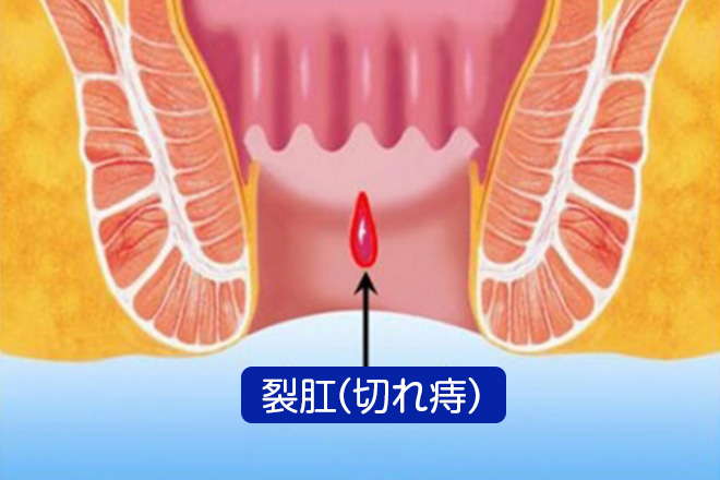 裂肛・キレ痔の症状
