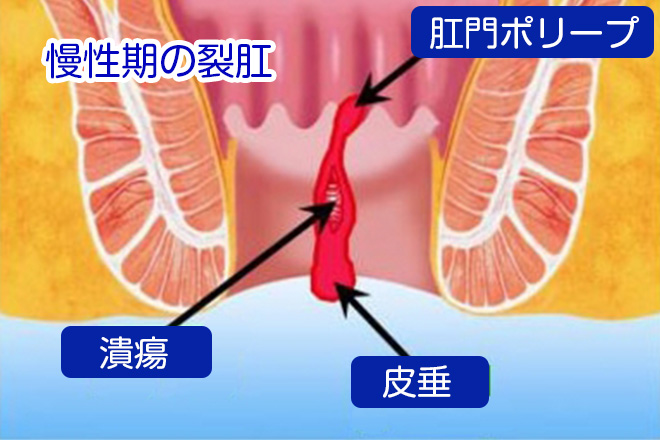 慢性化した裂肛