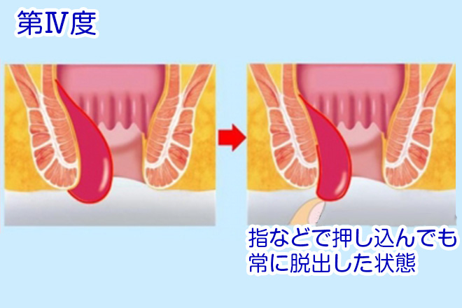 第Ⅳ度の内痔核
